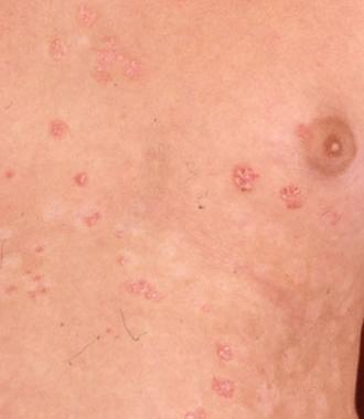 Psoriasis guttata