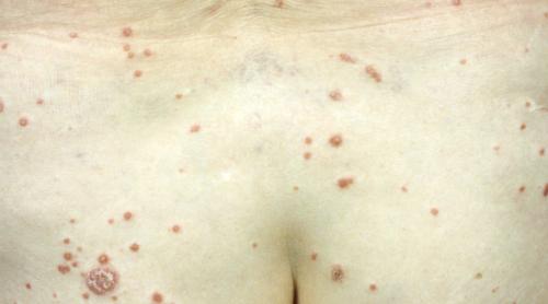 Psoriasis guttata