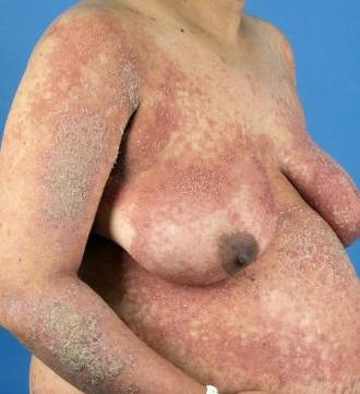 Generalisierte pustulse Psoriasis in der Schwangerschaft