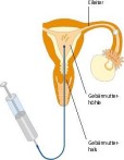 Intrauterine Insemination