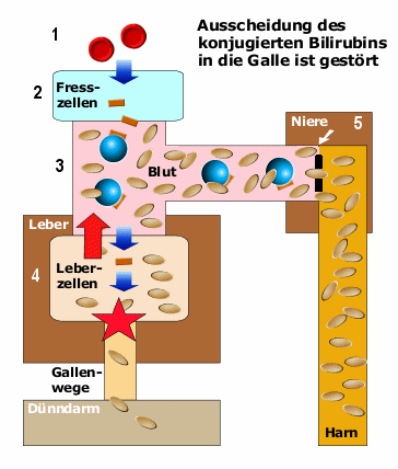 Schema des hepatischen Ikterus mit Erhhung des konjugierten, direkten Bilirubins (1)