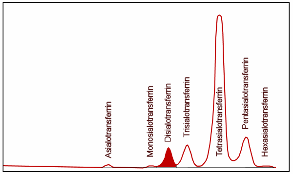 HPLC-Auftrennung der Transferrinvarianten eines Alkoholikers