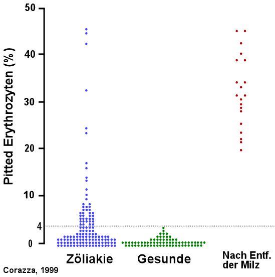 Pitted Erythrozyten sind auch bei unbehandelter Zliakie des Erwachsenen erhht