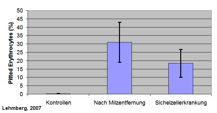 Pitted Erythrozyten bei Sichelzellerkrankung und nach Milzentfernung stark erhht