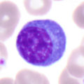 Atypischer Lymphozyt, vermutlich reaktiv (plasmazytoid, A.Wood, Typ C)