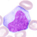 Atypischer Lymphozyt, vermutlich reaktiv (Virozyt, Downey II)