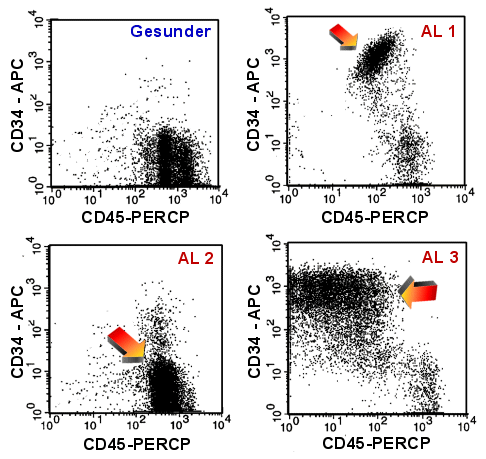 Die Markierung mit CD45 und CD34 zur Erkennung von unreifen Zellen