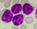 4 auffllige Lymphozyten