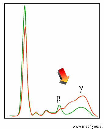 Kurve bei Leberzirrhose (rot): Beta-Gamma-Typ. Normalkurve grn.