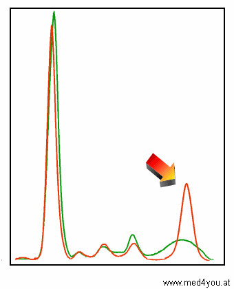 Kurve bei Paraproteinmie (rot), Normalkurve grn.