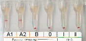 Serumgegenprobe (A1, A2, B und 0-Zellen) bei Blutgruppe B inkl. Antikrperscreening bei Raumtemperatur