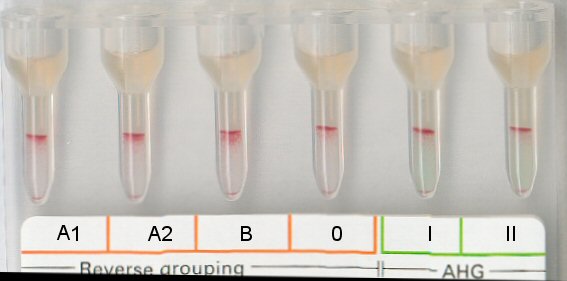 Serumgegenprobe bei Bombay-Typ