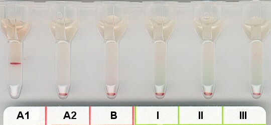 Serumgegenprobe bei irregulrem Anti A1-IgM