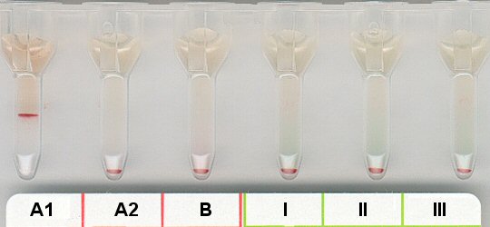 Serumgegenprobe bei irregulrem Anti A1-IgM