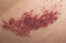 Gefentzndung (Vaskulitis) verursacht Blutungen - violette Flecken (Purpura) der Haut